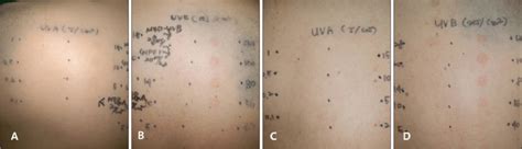 A photosensitivity test showed a markedly decreased minimum erythema ...