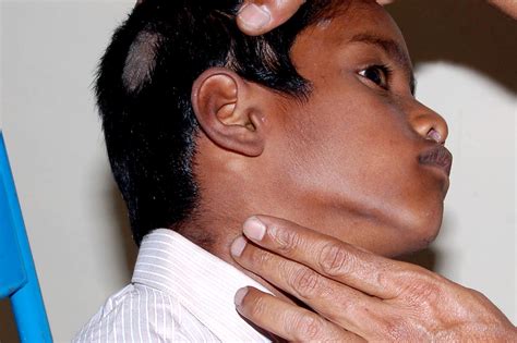 Swollen Lymph Node Behind The Ear - vrogue.co