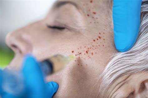 What is PRP skin treatment? (Platelet-Rich Plasma)