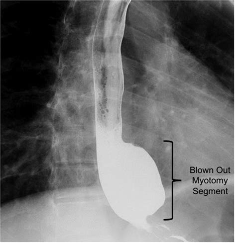 BLOWN OUT MYOTOMY (BOM): A COMPLICATION OF LAPAROSCOPIC HELLER MYOTOMY