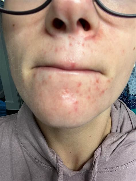 How did I go from clear skin to this? I don’t understand! I’ve always