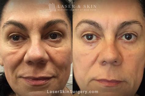 festoons bags  eyes  york ny laser center