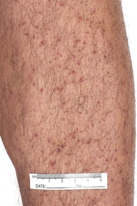 RACGP - A rare cause of petechial rash in the 21st century