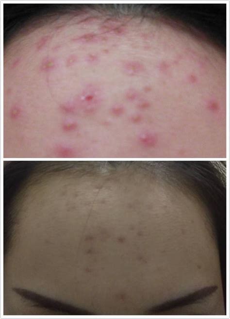 Acne Clear Treatment, Beauty & Personal Care, Face, Face Care on Carousell