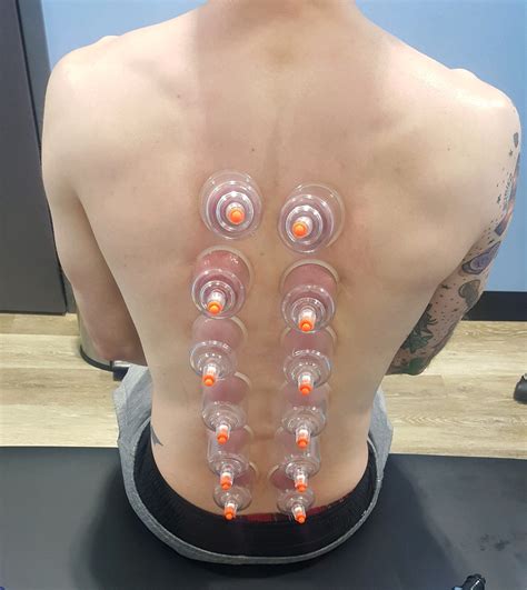 List 95+ Pictures Cupping Before And After Pictures Full HD, 2k, 4k