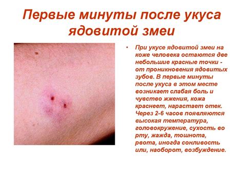 Первая помощь при укусах змей и насекомых - online presentation