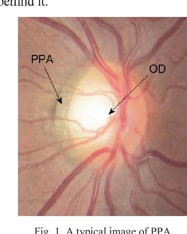 figure   automatic segmentation  ppa  retinal images