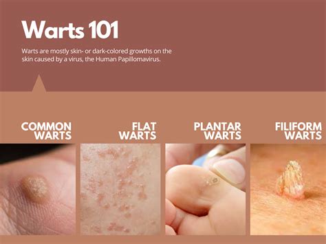 Flat Warts On Hands Removal