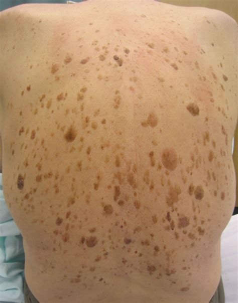 Benign skin lesions definition, common benign skin lesions diagnosis
