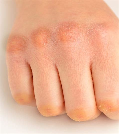 dark knuckles   treatment