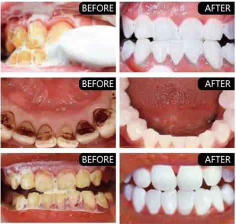 Hismile V34 Colour Corrector Teeth Whitening Serum - 30 ml 744109218965 ...