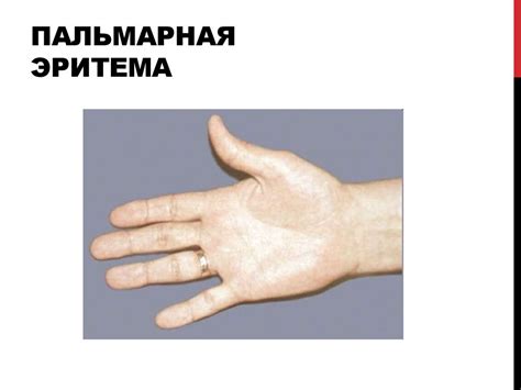Цирроз печени - online presentation