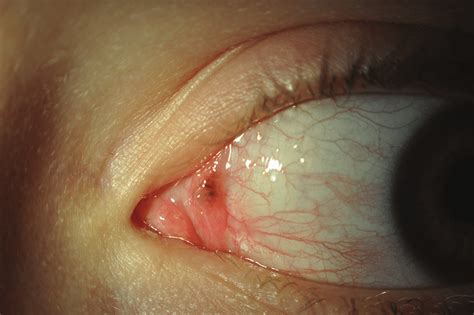 Same conjunctival lesion by the 15 th month, showing almost complete ...