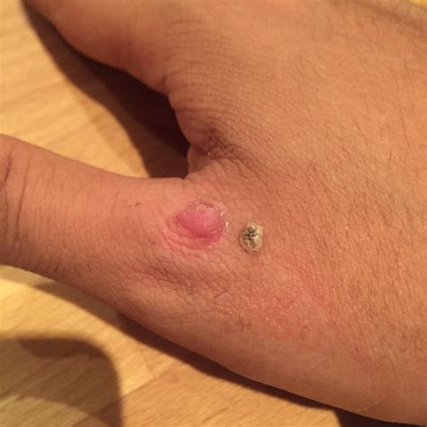 Did I kill this whole wart? No crater satisfaction :\ What do you think