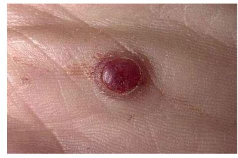 Haemangioma - Focus Dentistry