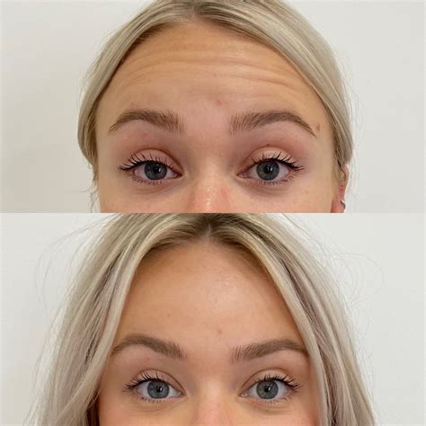 frown line botox 7