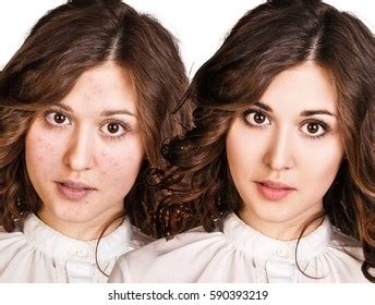 Girl Acne Before After Treatment Stock Photo 590393219 | Shutterstock