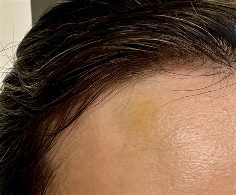 [routine help] for bruise on forehead : r/SkincareAddiction