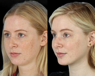 hyperpigmentation    dr anil shah