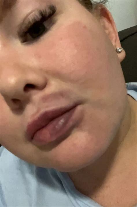 Woman looked 'like Monsters Inc character with sausage lips' after ...