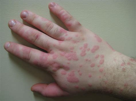 erythema multiforme definition  erythema multiforme