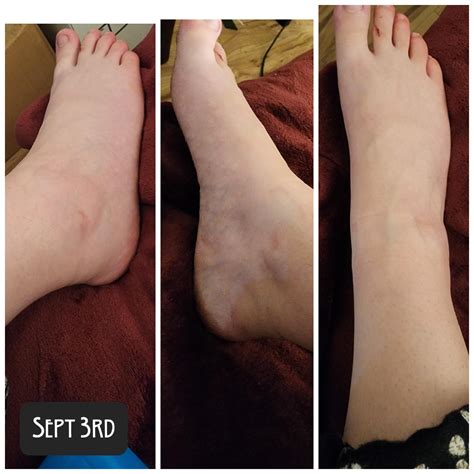 What degree is my ankle sprain? CW: Feet : r/medical