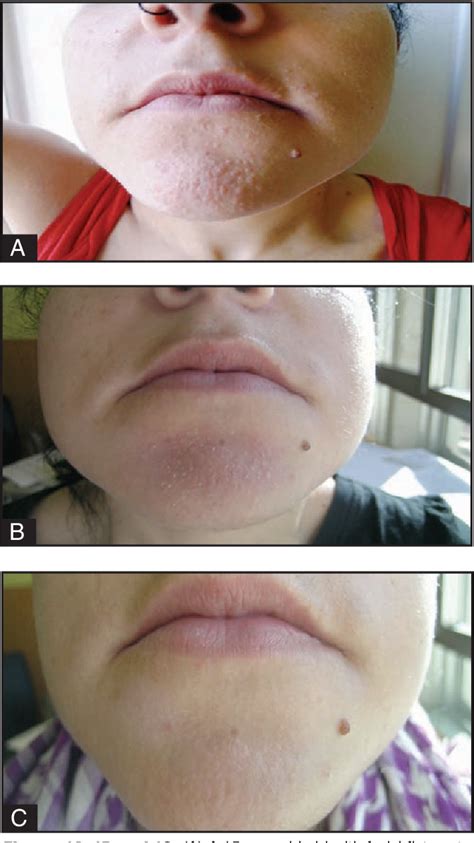 flat warts  face treatment cream discount offers wwwoceanproperty