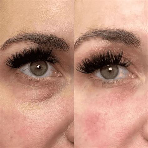 prf ez gel  eye  transforming tear trough results hubmed