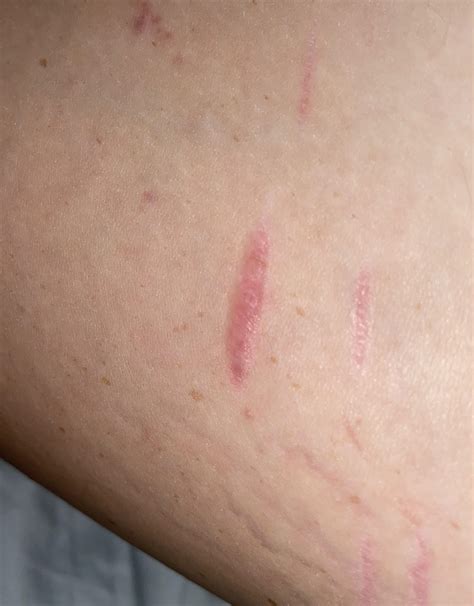 why does my scar hurt pretty bad? it’s been fully healed for abt 3