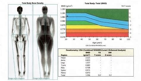 Dexa Scan | Bone Mineral Density Tool | ARC Recovery & Rehabilitation