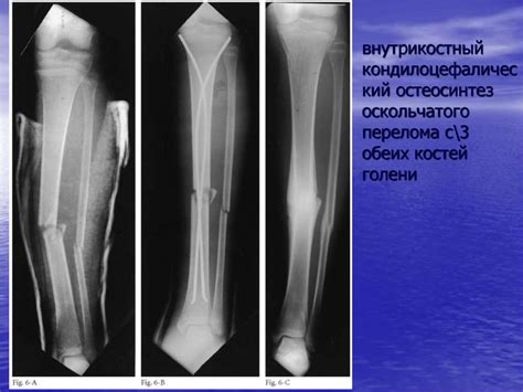 Рентген-диагностика повреждений голени и голеностопного сустава ...