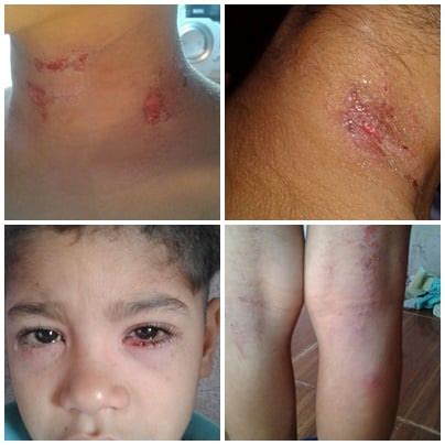 Doença Do Pombo Na Pele - Pombos invadem escola municipal e causam doença de pele em aluno ...