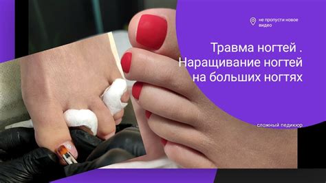 Травма ногтей.Сложный ПЕДИКЮР. Наращивание больших ногтей на ногах ...