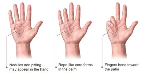 Dupuytren’s Contracture – Tran Plastic Surgery