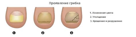 Виды грибка ногтей с фото - Симптомы и лечение болезней