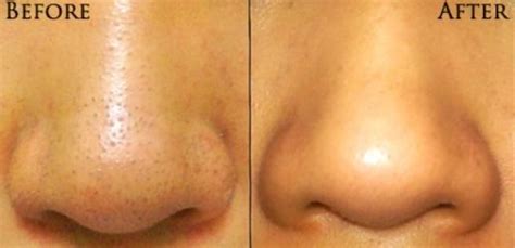 DIY Blackhead Remover Recipe Popular on Pinterest - lil bit
