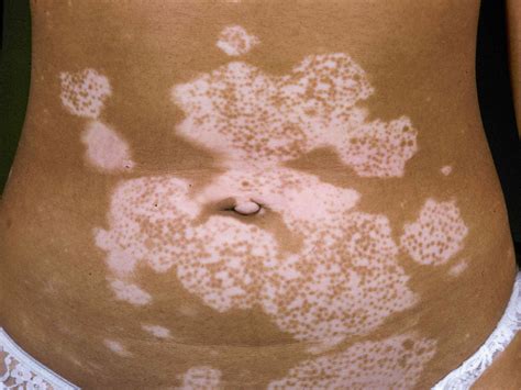 What Causes White Spots On Skin That Won T Tan Reddit - Infoupdate.org