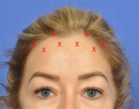 The BOTOX® Brow Lift Revisited - W Cosmetic Surgery | Botox brow lift ...