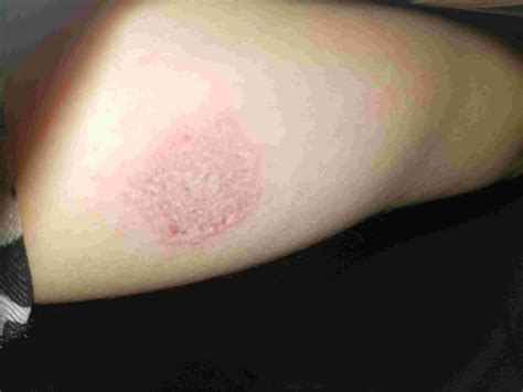 I went 2 the doctor for a really bad rash that is itchy & circular