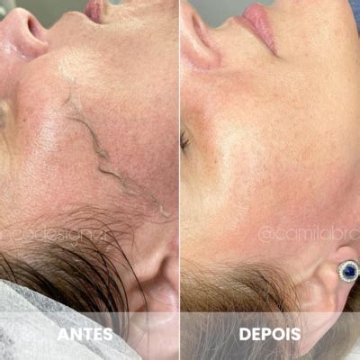 Dermaplaning Para Que Serve - Para que serve o Dermaplaning? Especialista explica tudo