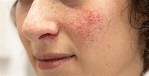 What is Rosacea? - SLMA