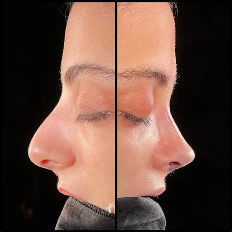 rhinoplasty turkey   inclusive