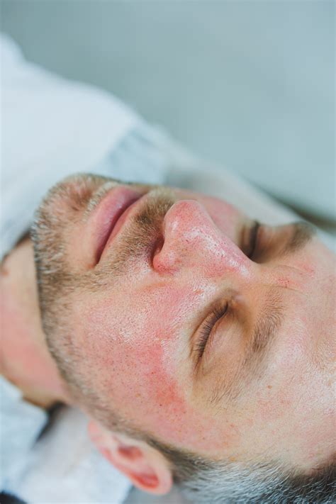 Discover Rosacea Treatments in Maidenhead: Your Path to Clearer Skin