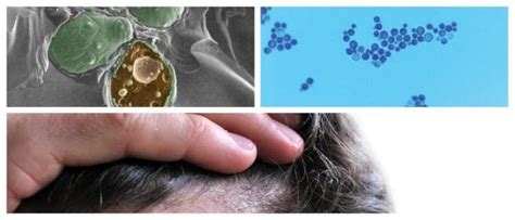Malassezia Globosa: Causes, Symptoms and Treatment – Hoool.com