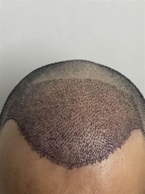 Day 5, not a lot of scabs,? : r/HairTransplants