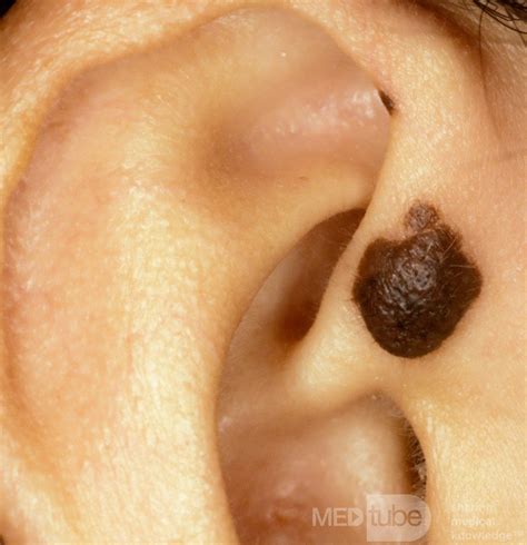 Intradermal Nevus • Image • MEDtube.net