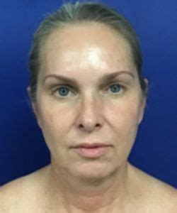 Top 5 Benefits of BeautiFill™ BBL Surgery | Kansas City
