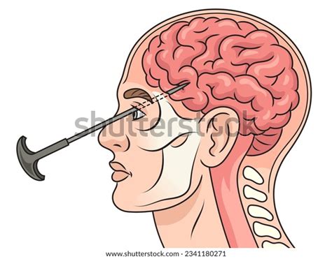 22 Leucotomy Images, Stock Photos & Vectors | Shutterstock