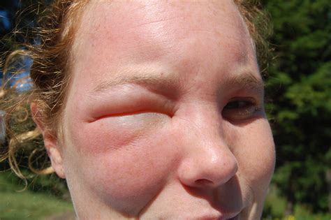 Wasp Sting Infection Signs