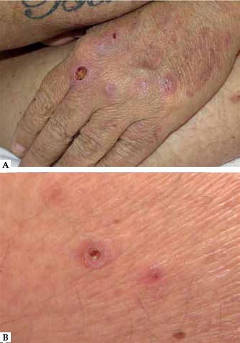 Perforating Folliculitis